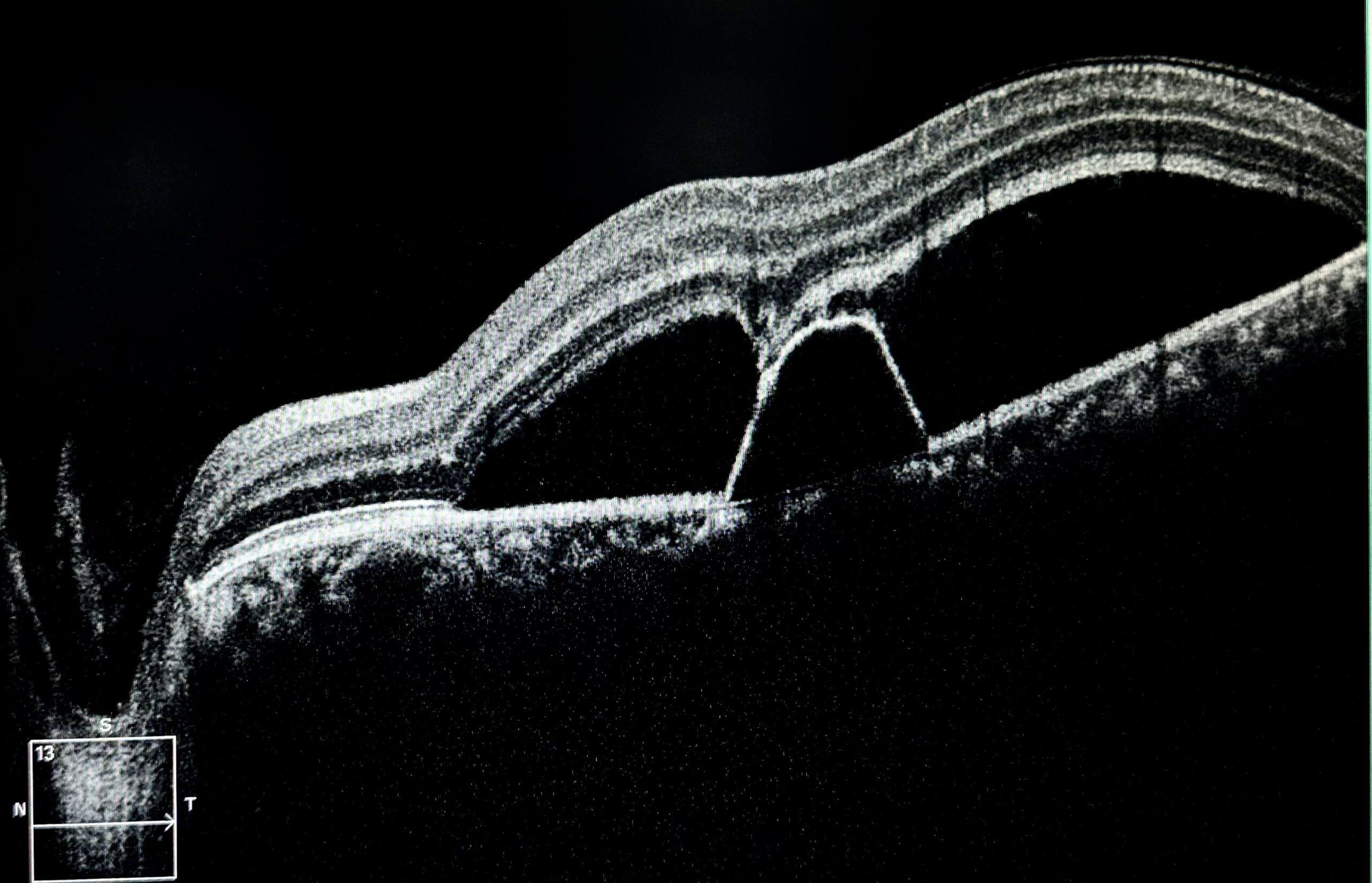Csr Eye Central Serous Chorioretinopathy - RetinaRA
