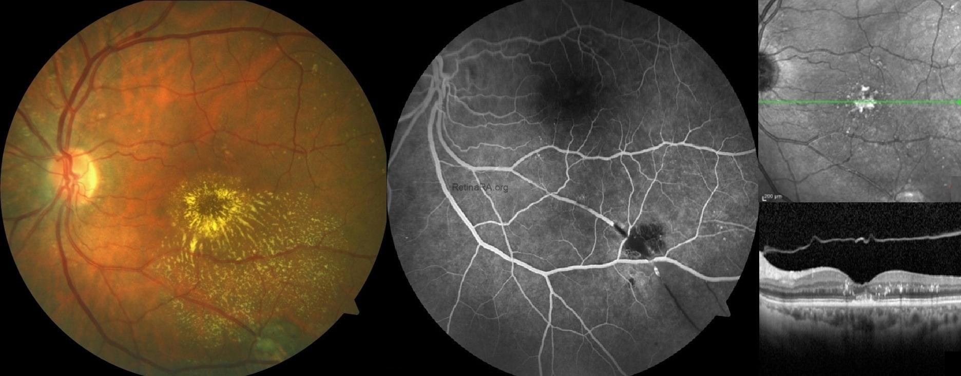 Ram Optometry Retinal Arterial Macroaneurysm - RetinaRA