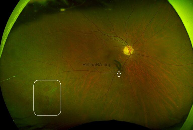Retinal Breaks and Treatment with Argon Laser Photocoagulation - RetinaRA