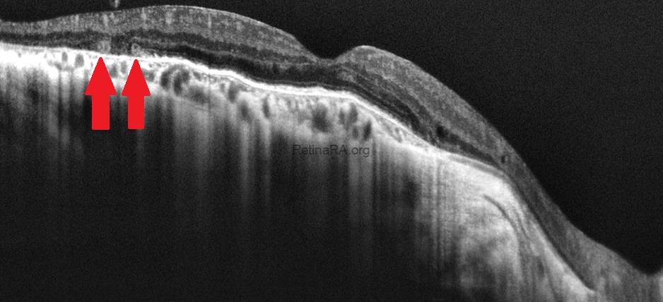 Choroideremia-oct.-1