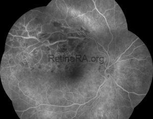 Collateral Vessels in Branch Retinal Vein Occlusion - RetinaRA