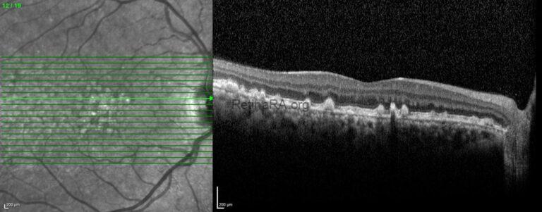 Basal Laminar Drusen - RetinaRA