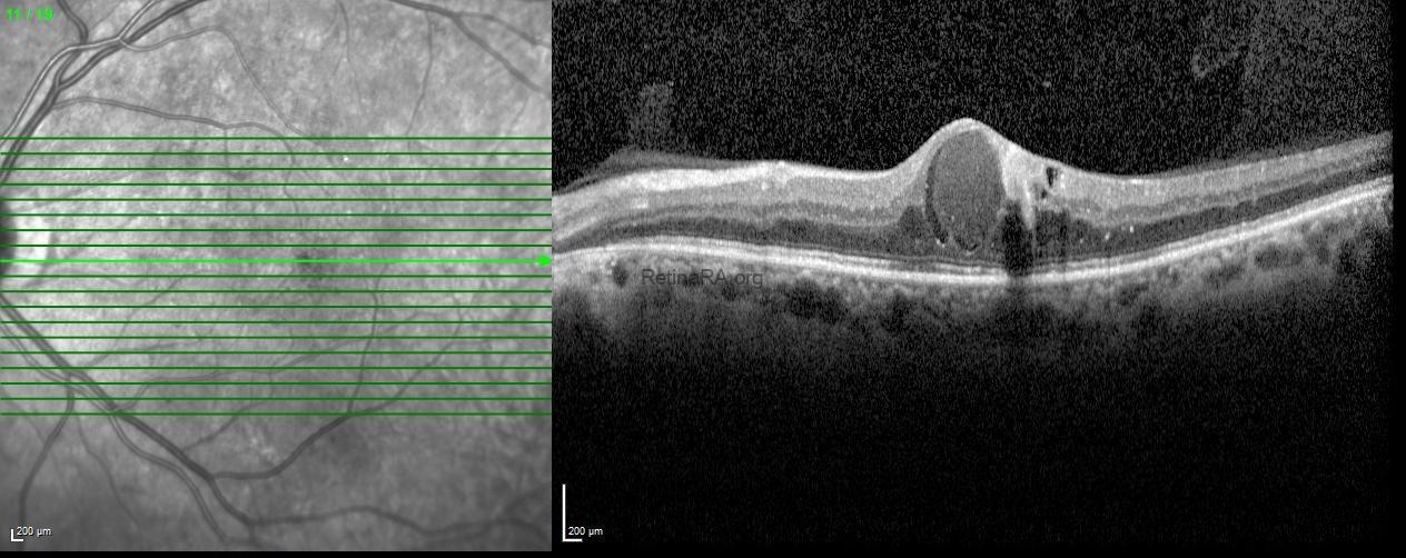 Intracystic Hyperreflective Material in Diabetic Macular Edema - RetinaRA
