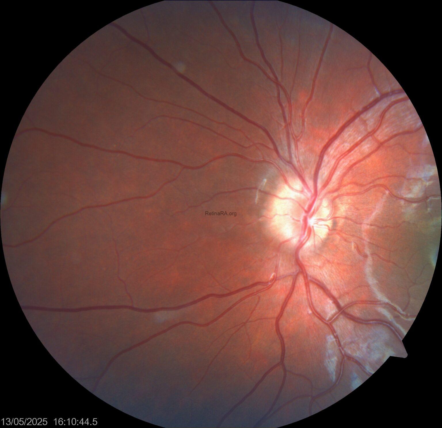 Ovoid Structures Peripapillary Hyperreflective Ovoid Mass-Like Structures (PHOMS) - RetinaRA