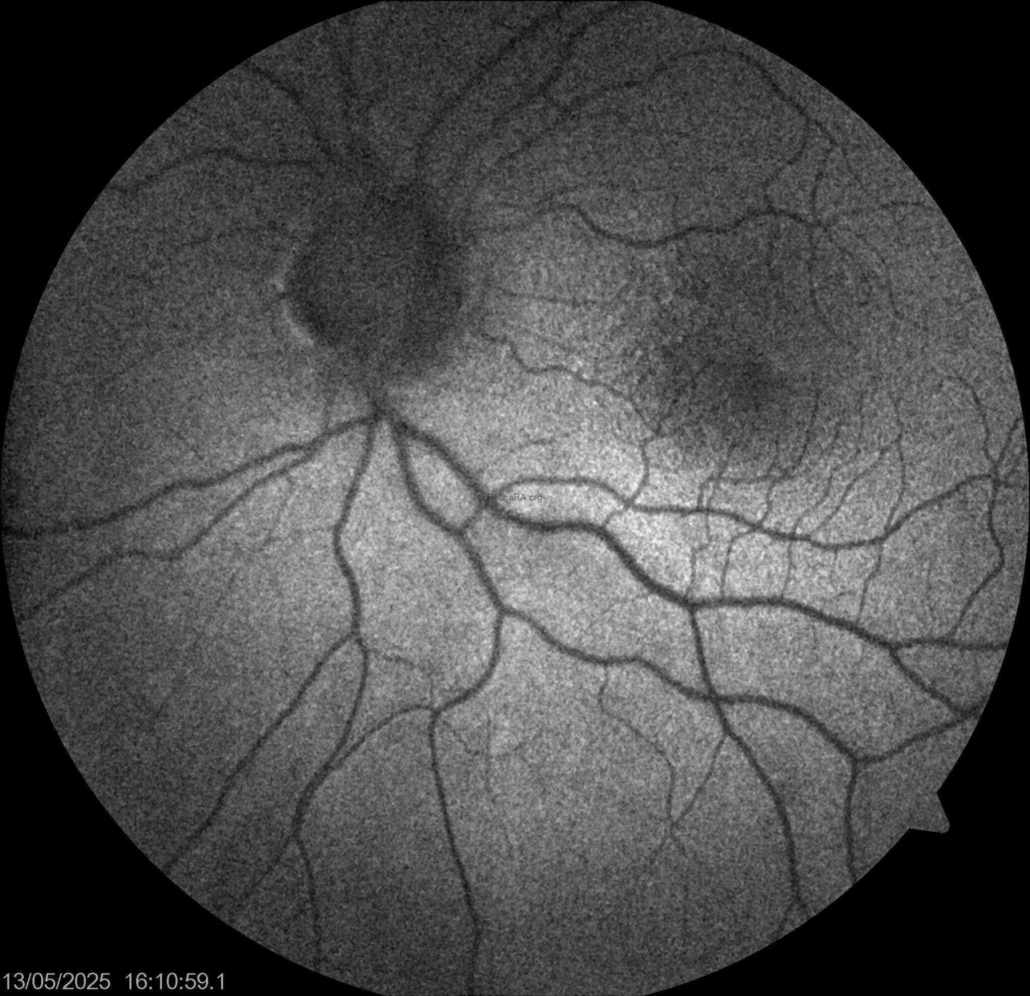 Ovoid Structures Peripapillary Hyperreflective Ovoid Mass-Like Structures (PHOMS) - RetinaRA