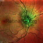 Papilledema - RetinaRA