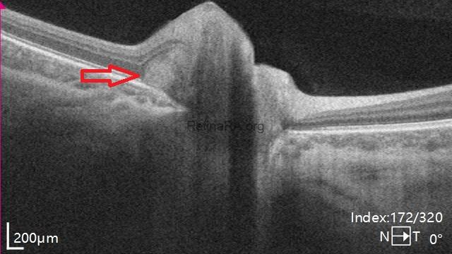 Hyper Reflective Defect Oct Peripapillary Hyperreflective Ovoid Mass-Like Structures (PHOMS) - RetinaRA