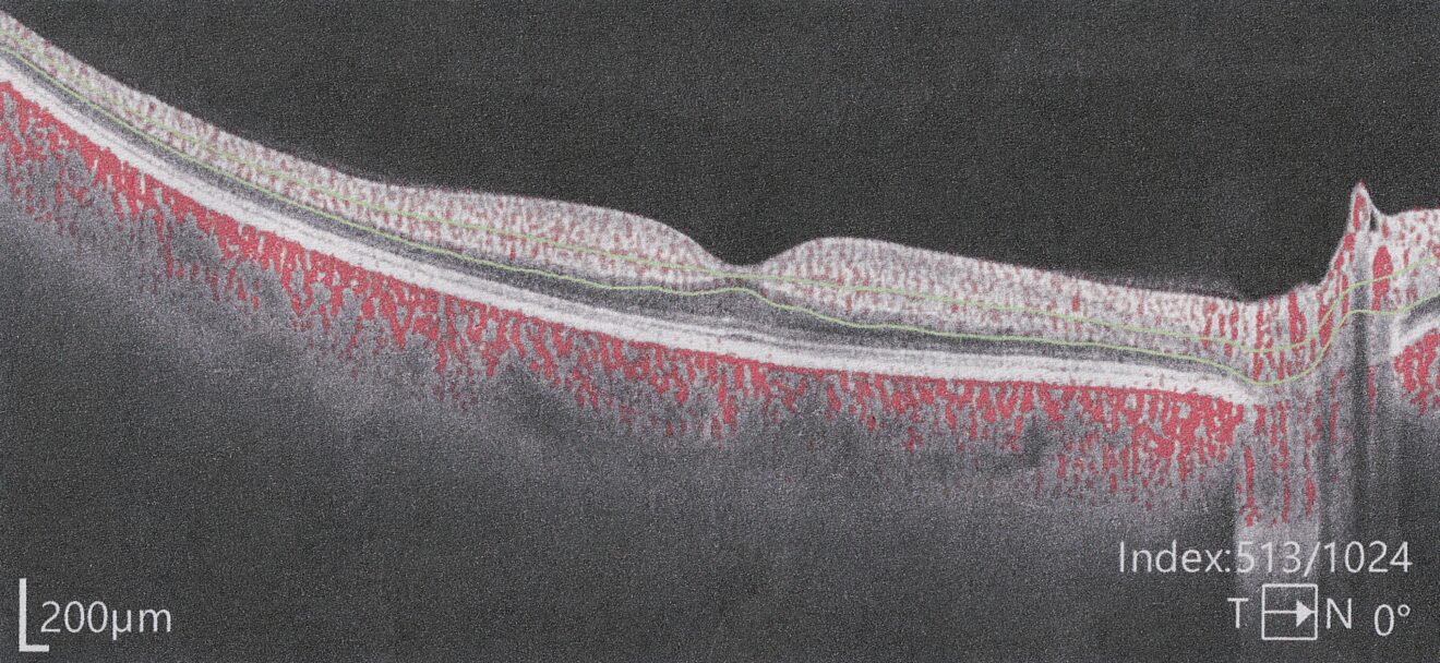 Branch Retinal Artery Occlusion - RetinaRA