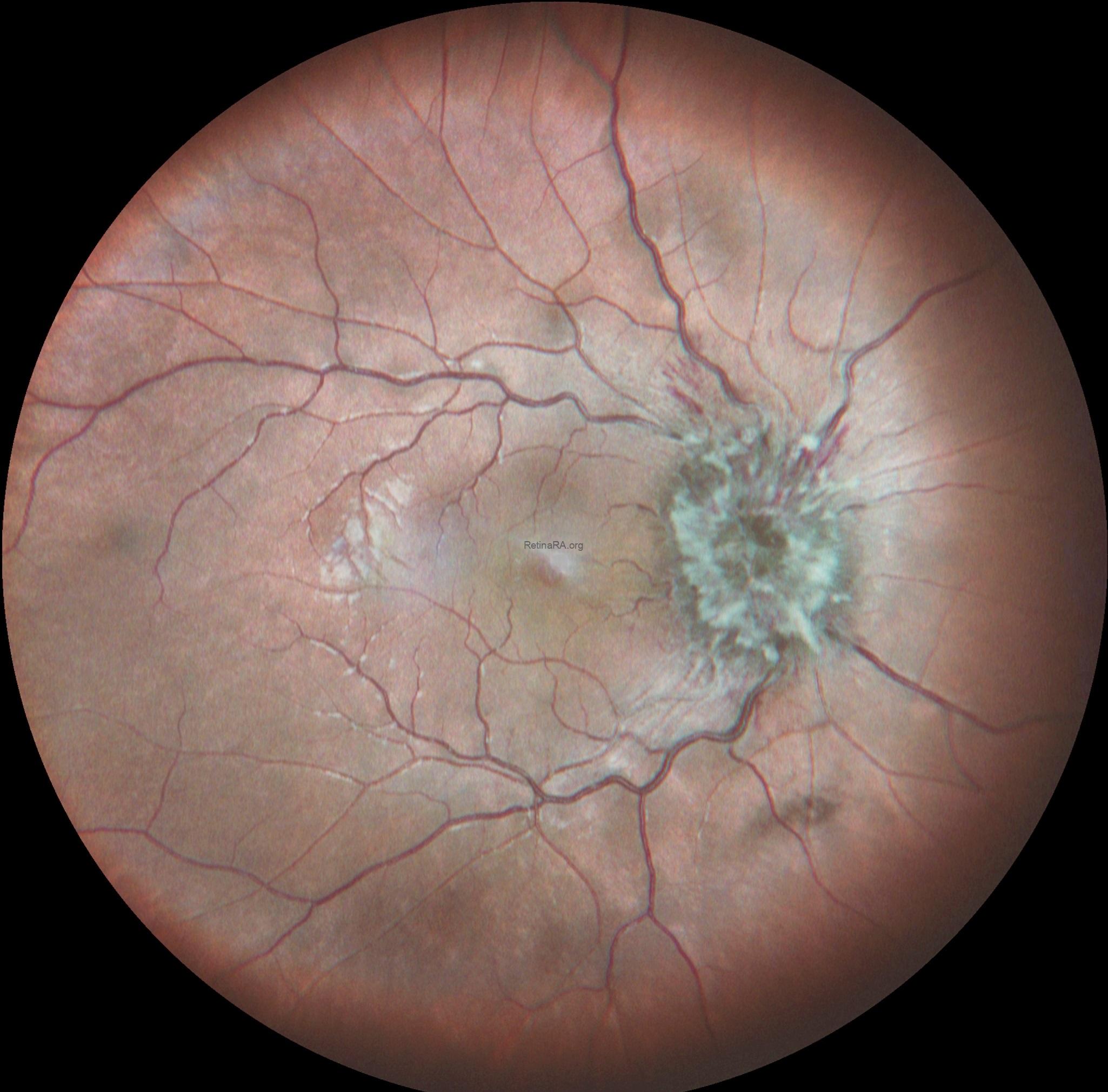 1Papilledema