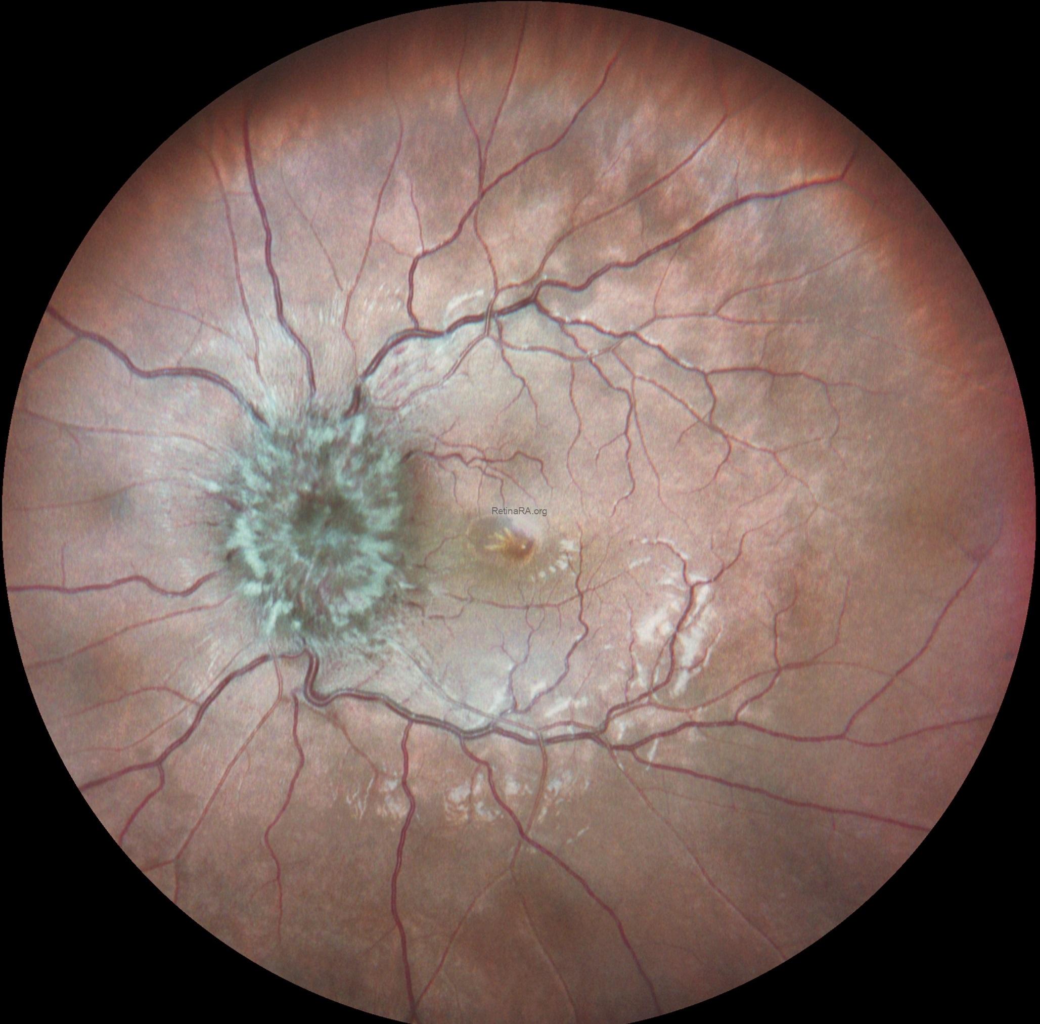 2Papilledema