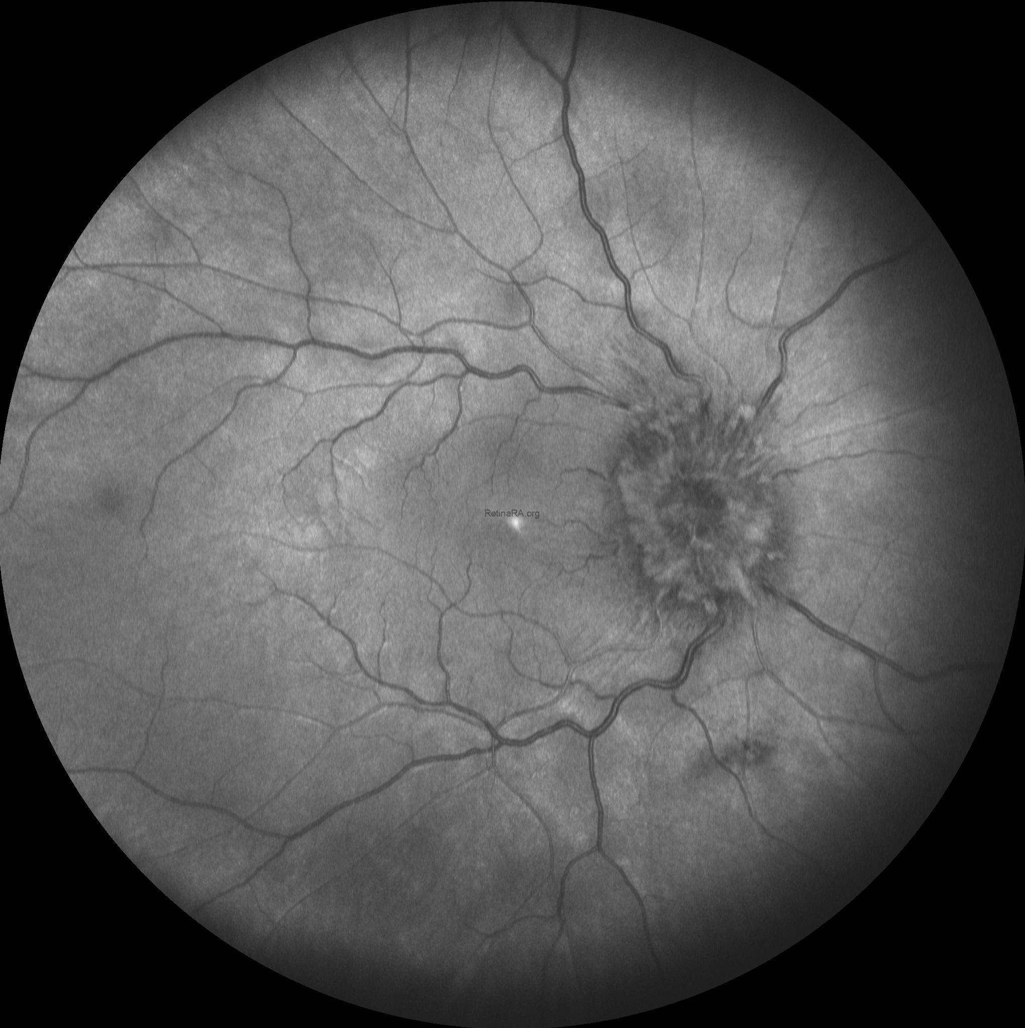 3Papilledema