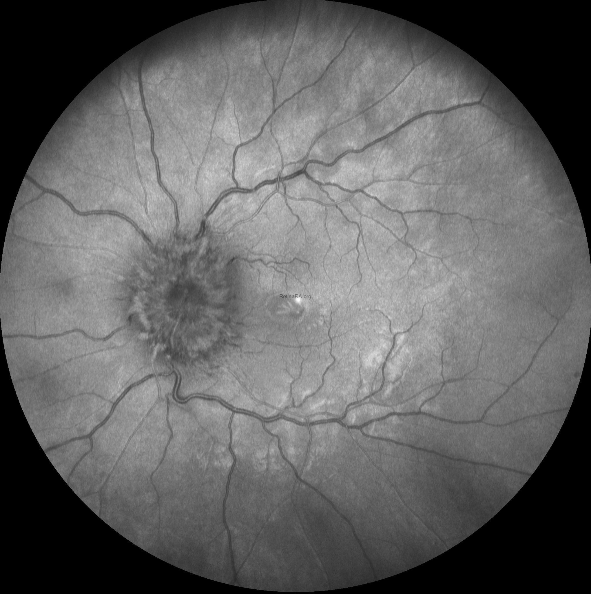 4Papilledema