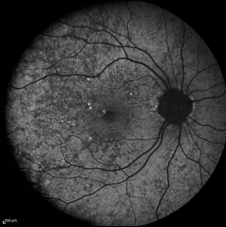 YILDIRIMN-KOROIDEREMI-TASIYICI_001-1r4suMJe