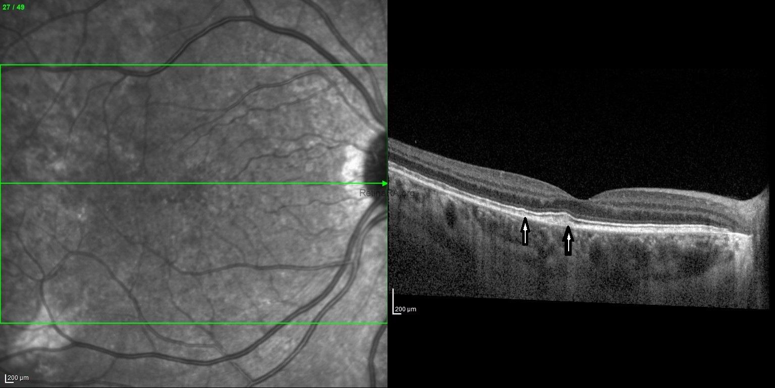 YILDIRIMN-KOROIDEREMI-TASIYICI_008026