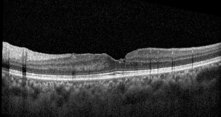 tractional-lamellar-macular-hole-postop-2