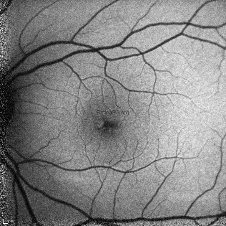 tractional-lamellar-macular-hole-postop-5