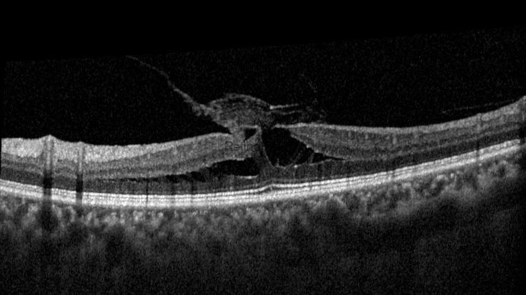 tractional-lamellar-macular-hole-preop-1-Kopya5iqI3Wt