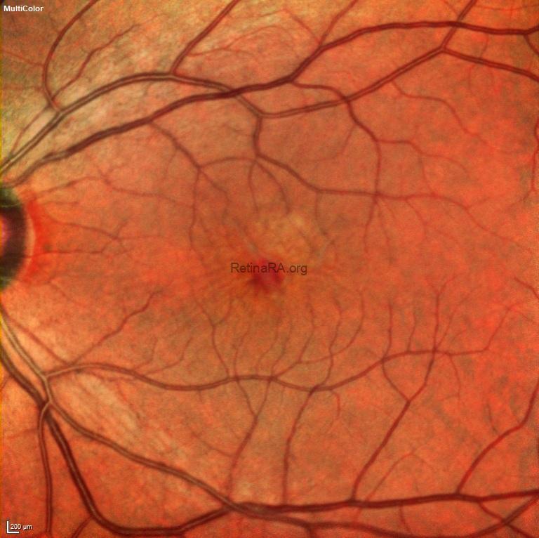 tractional-lamellar-macular-hole-preop-4