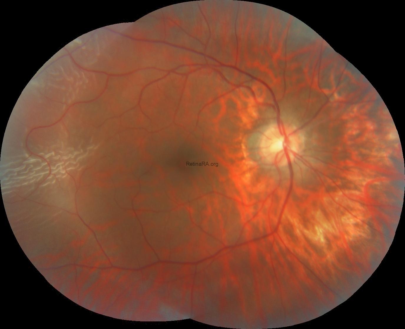 Retinal Repair Radiopaedia Rhegmatogenous Retinal Detachment Repair without Using Perfluorocarbon ...