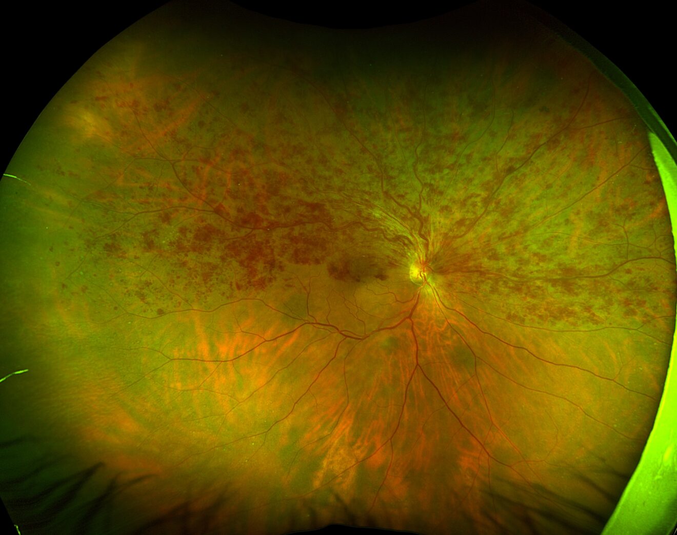 Hemiretinal Vein Occlusion - RetinaRA