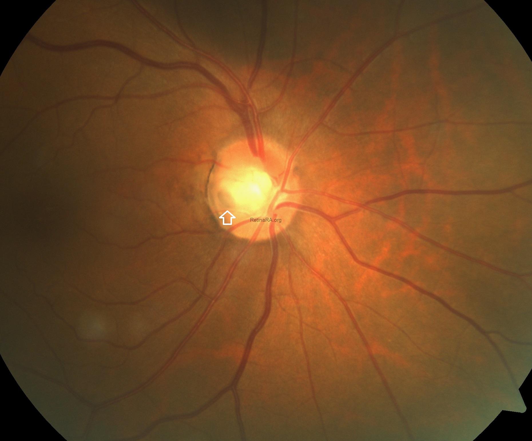 Optic Disc Insert Bilateral Optic Disc Pit - RetinaRA