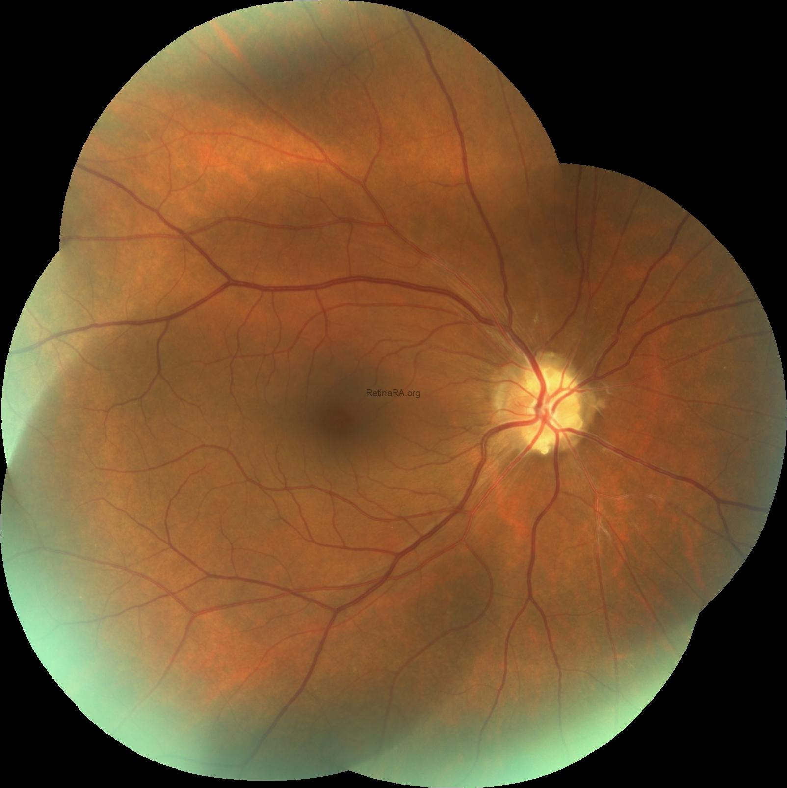 3opticnervedrusen