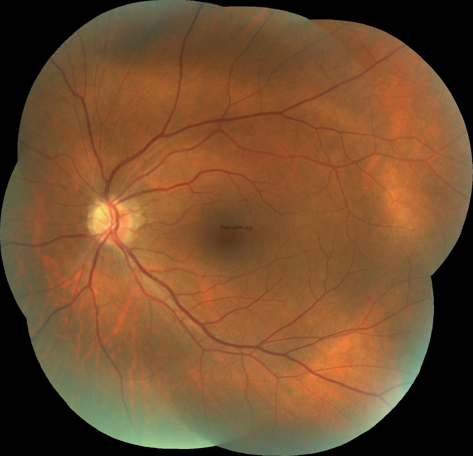 4opticnervedrusen