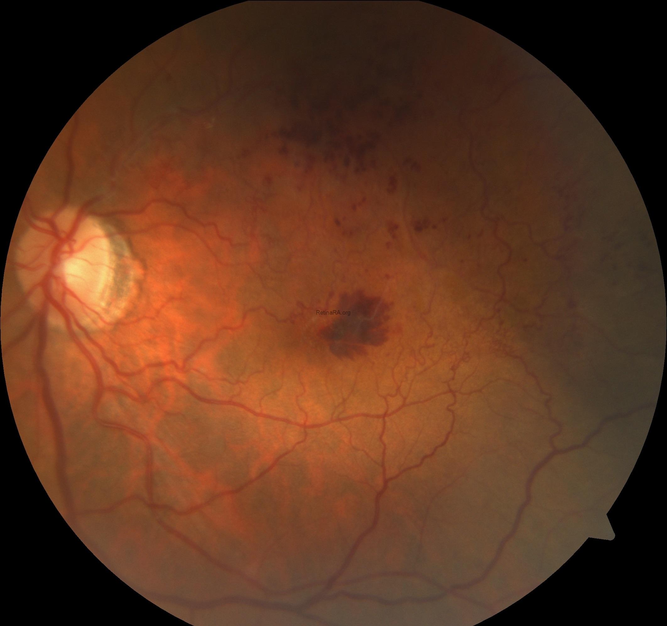 1henlefiberlayer-hemorrhage