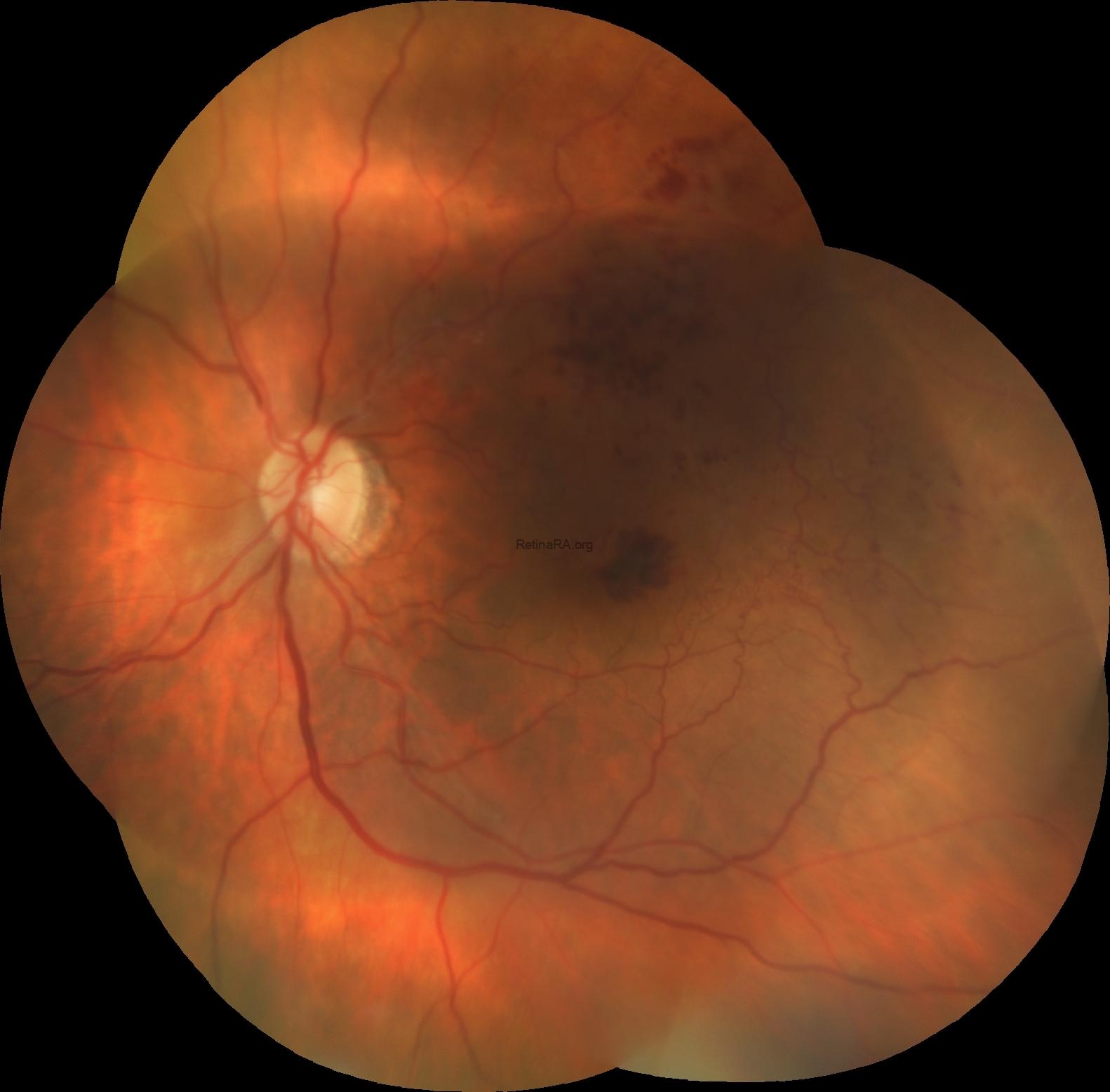 2henlefiberlayer-hemorrhage