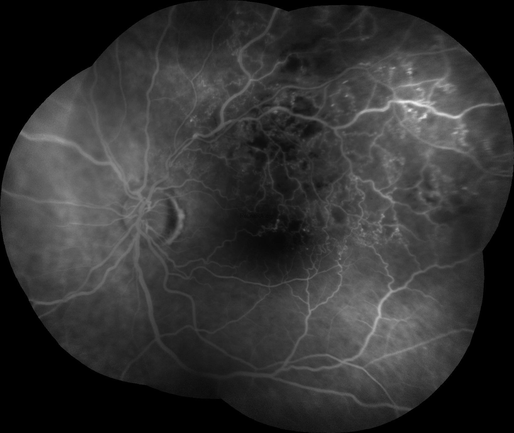 3henlefiberlayer-hemorrhage