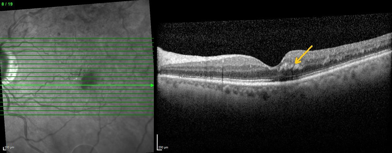 4henlefiberlayer-hemorrhage