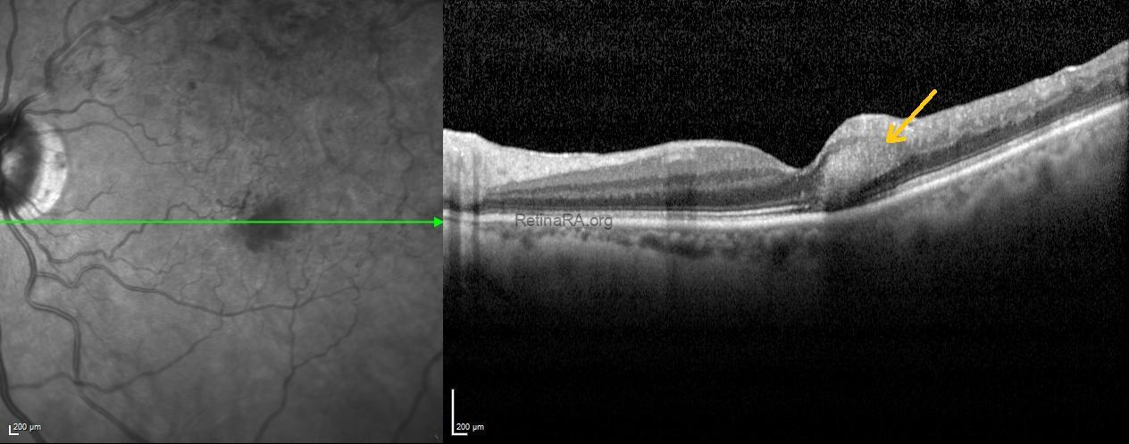 5henlefiberlayer-hemorrhage