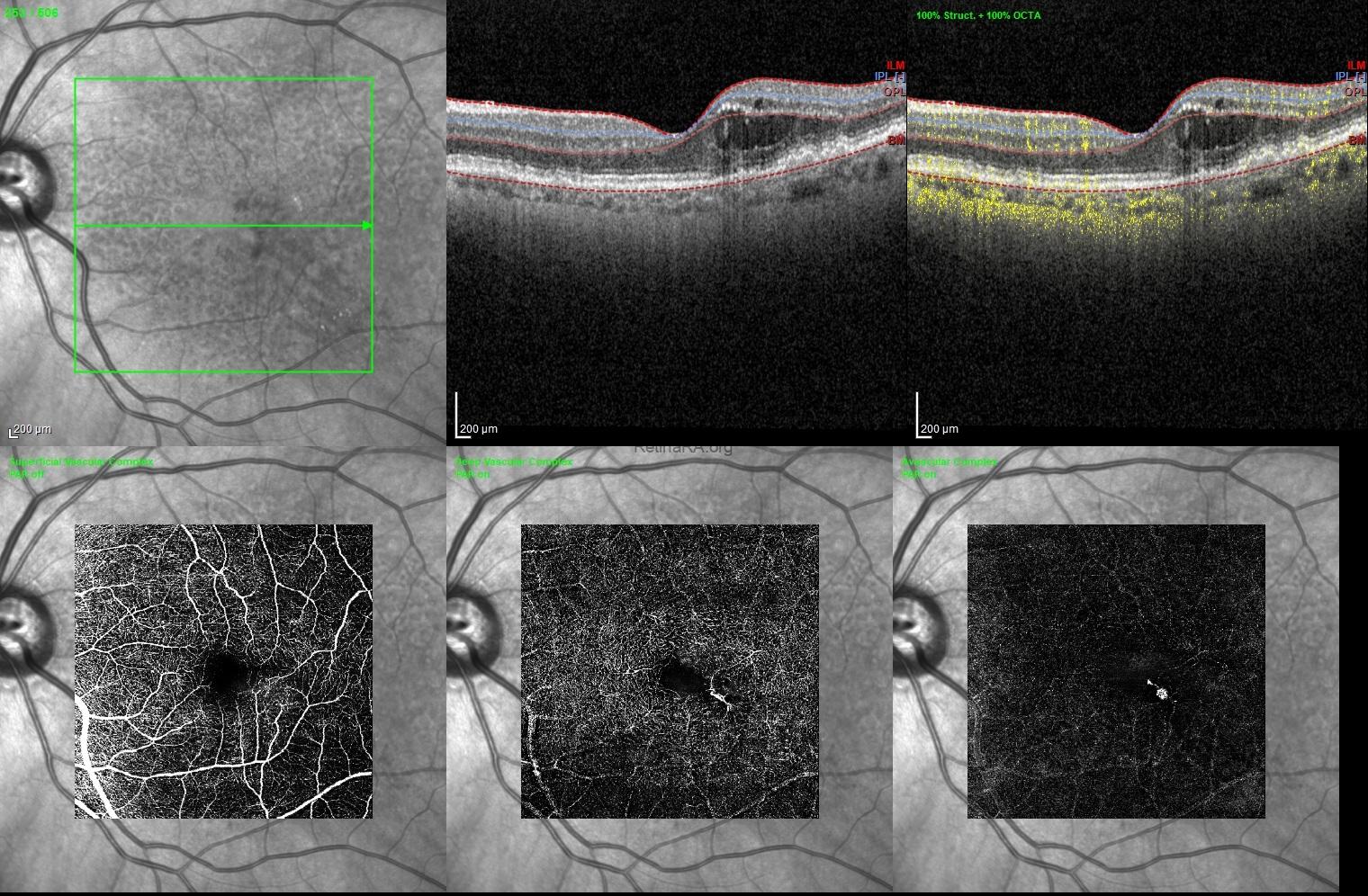 Retinal Angiomatous Proliferation (RAP) - RetinaRA
