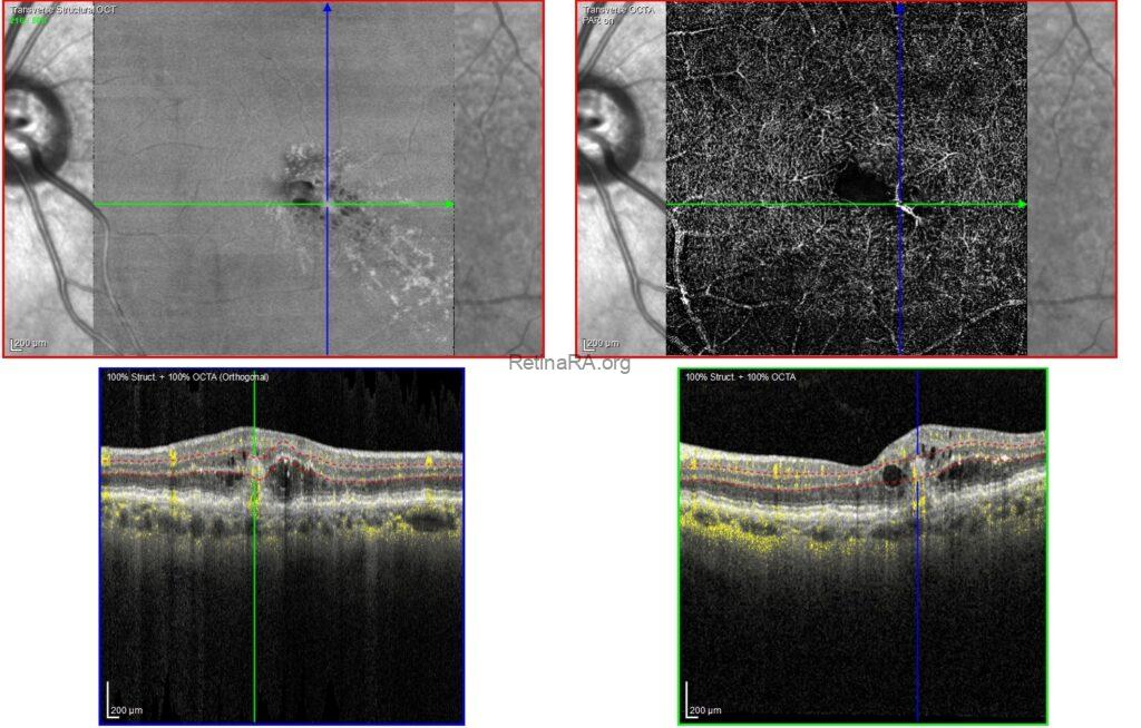 Retinal Angiomatous Proliferation (RAP) - RetinaRA