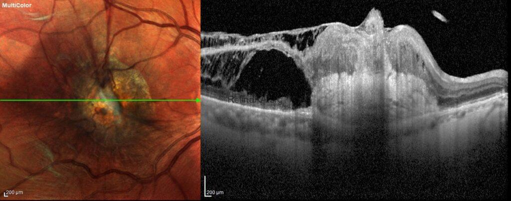 Retinal Angiomatous Proliferation (RAP) - RetinaRA