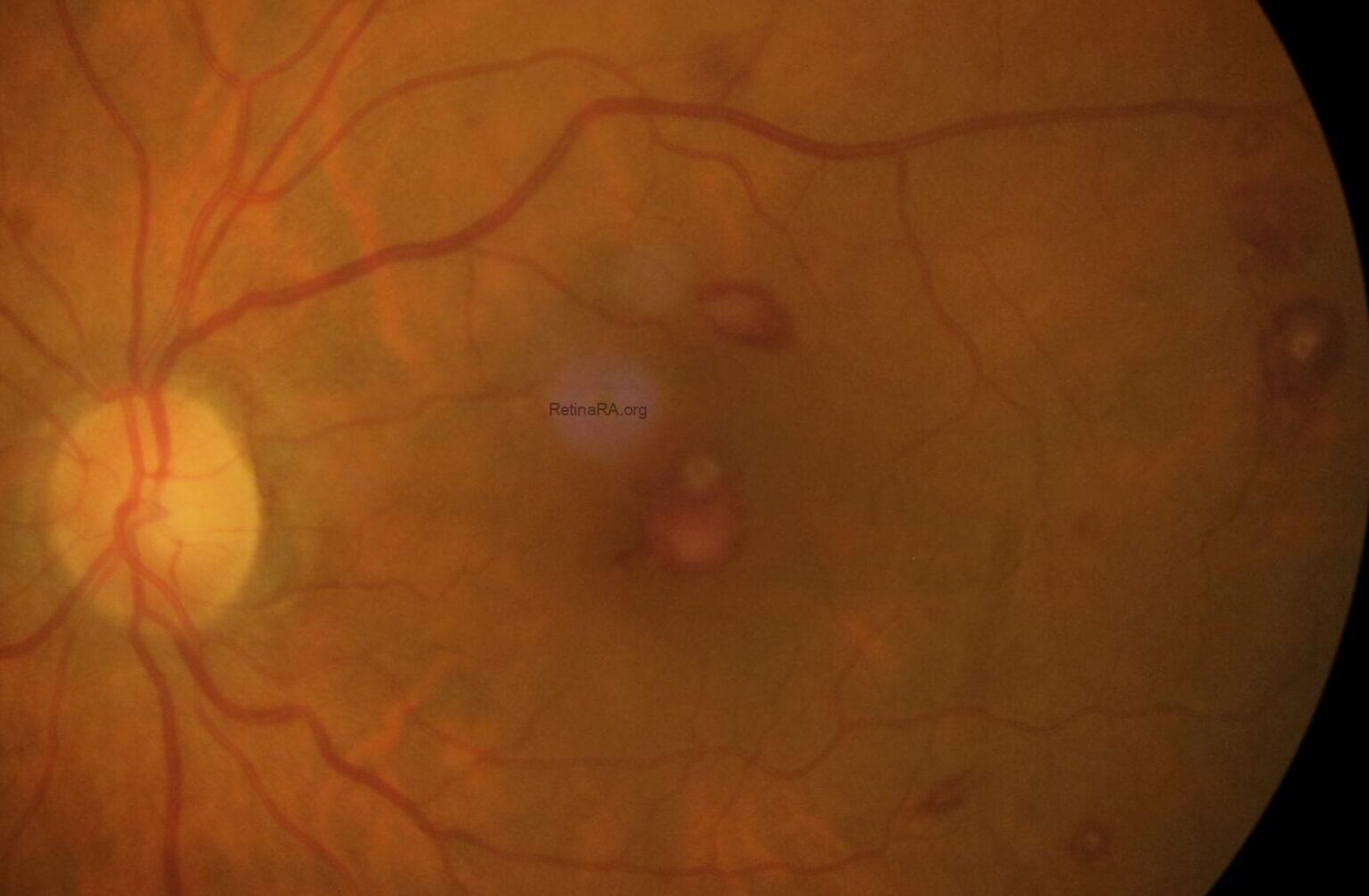 Single Roth Spots Diabetes A Red-White Clue to Systemic Disease: Roth Spot - RetinaRA