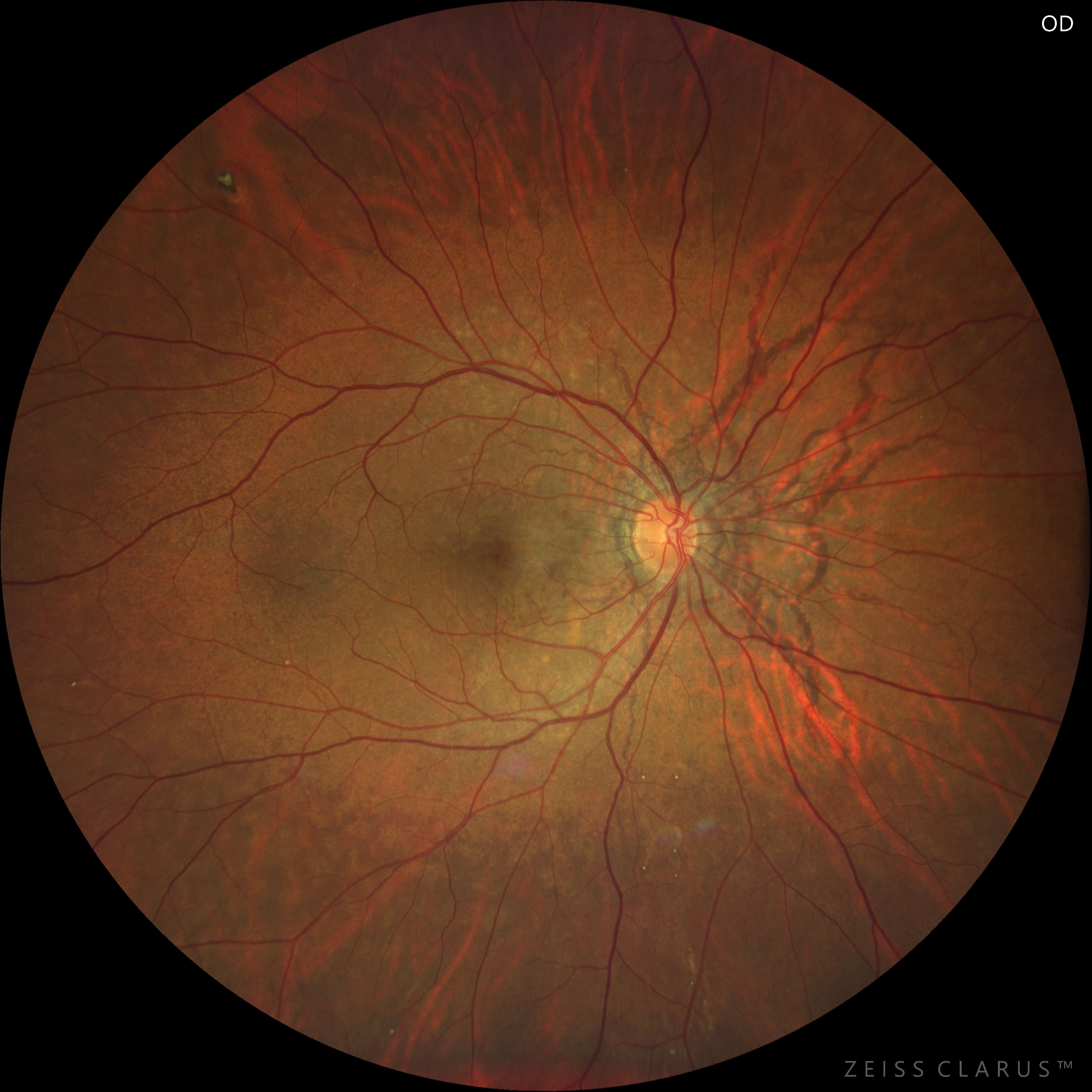 1angioidstreaks2Jik72i