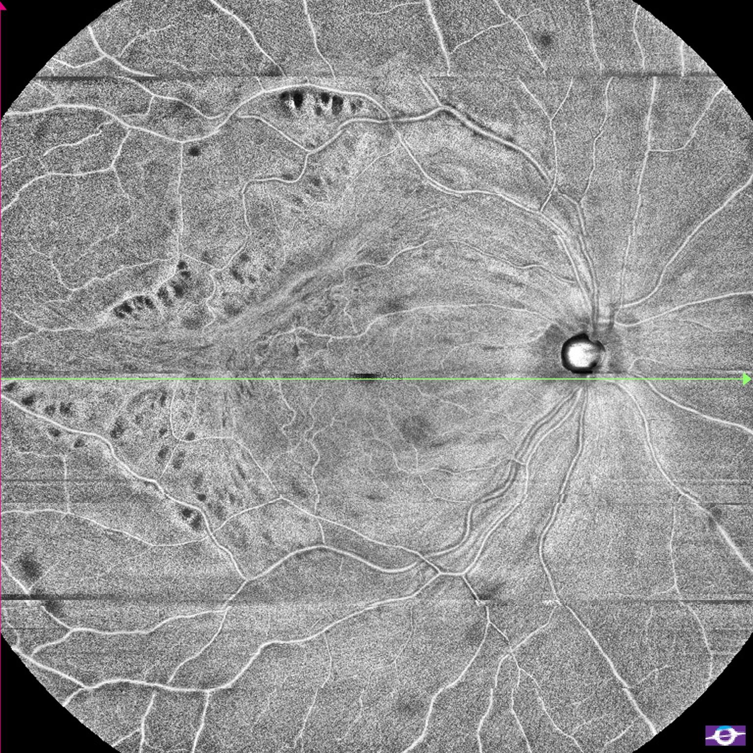 postoperative-tightly-adherent-ERm-1