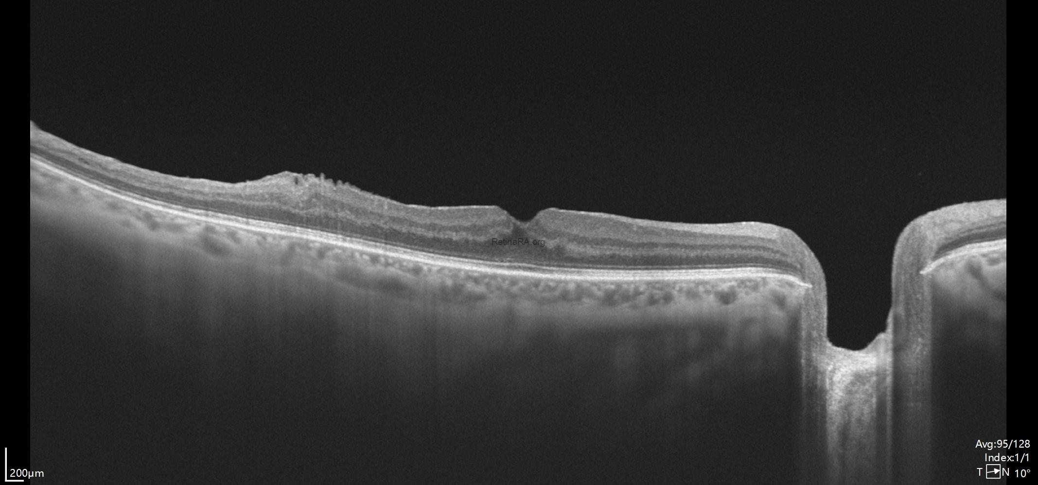 postoperative-tightly-adherent-ERm-2