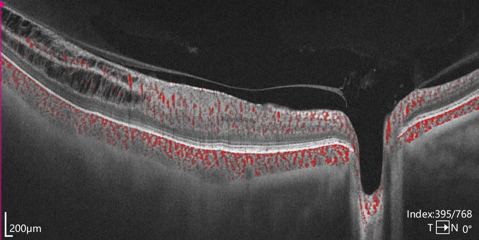 tightly-adherent-erm-1