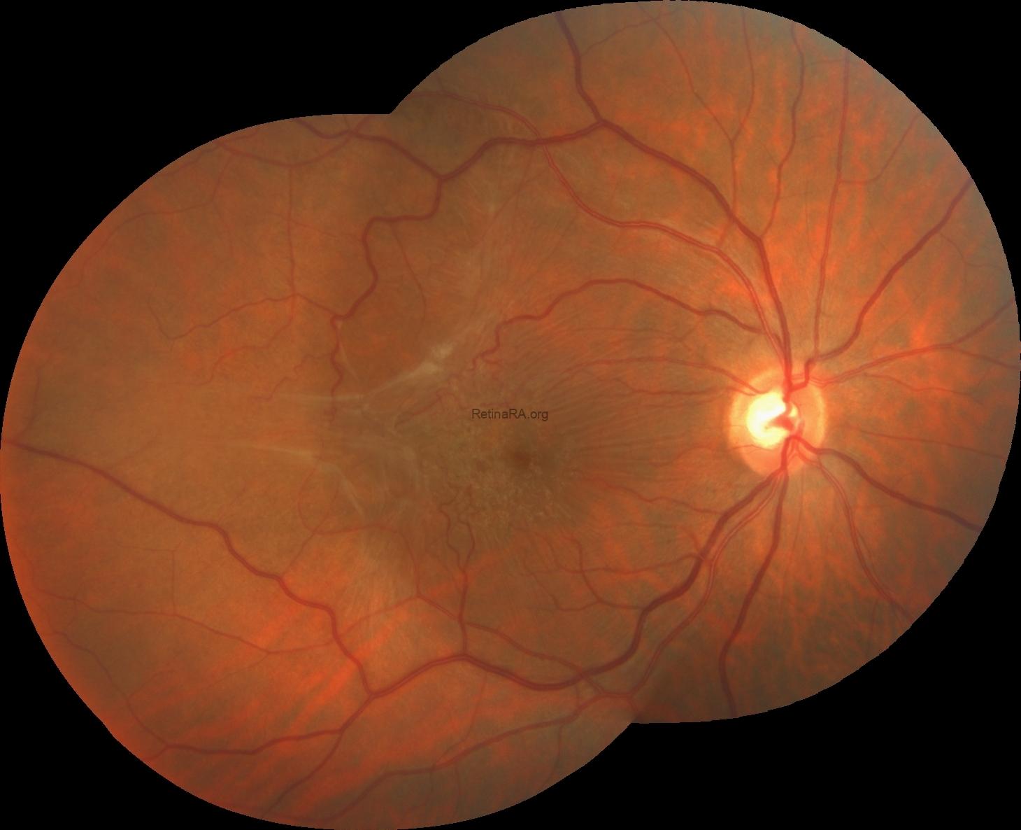 tightly-adherent-erm-2