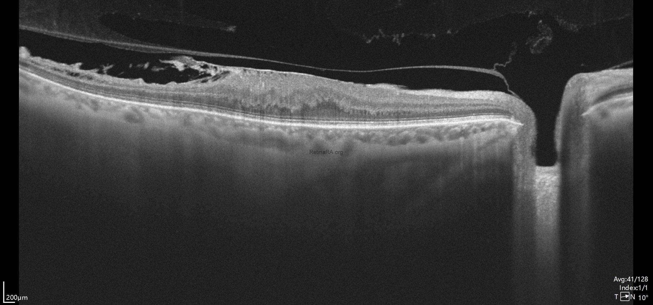 tightly-adherent-erm-3