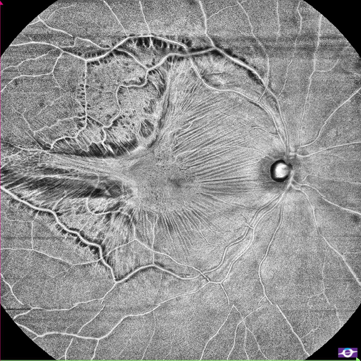 tightly-adherent-erm-4VlC8qJZ