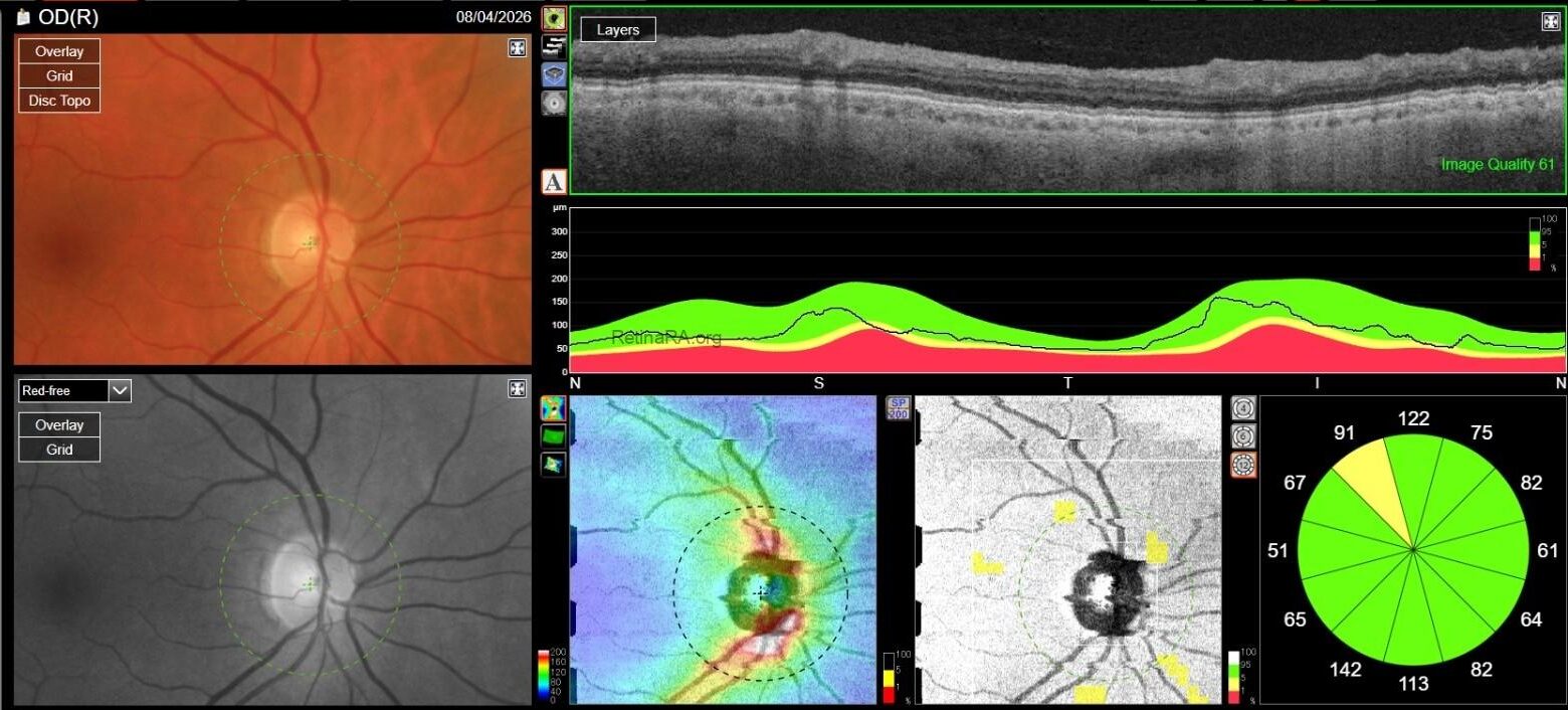 OCT-RNFL-OD-copia