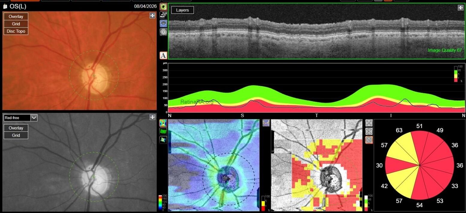 OCT-RNFL-OS-copia