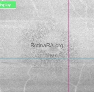 OCT-en-face-OS-264IF5yo