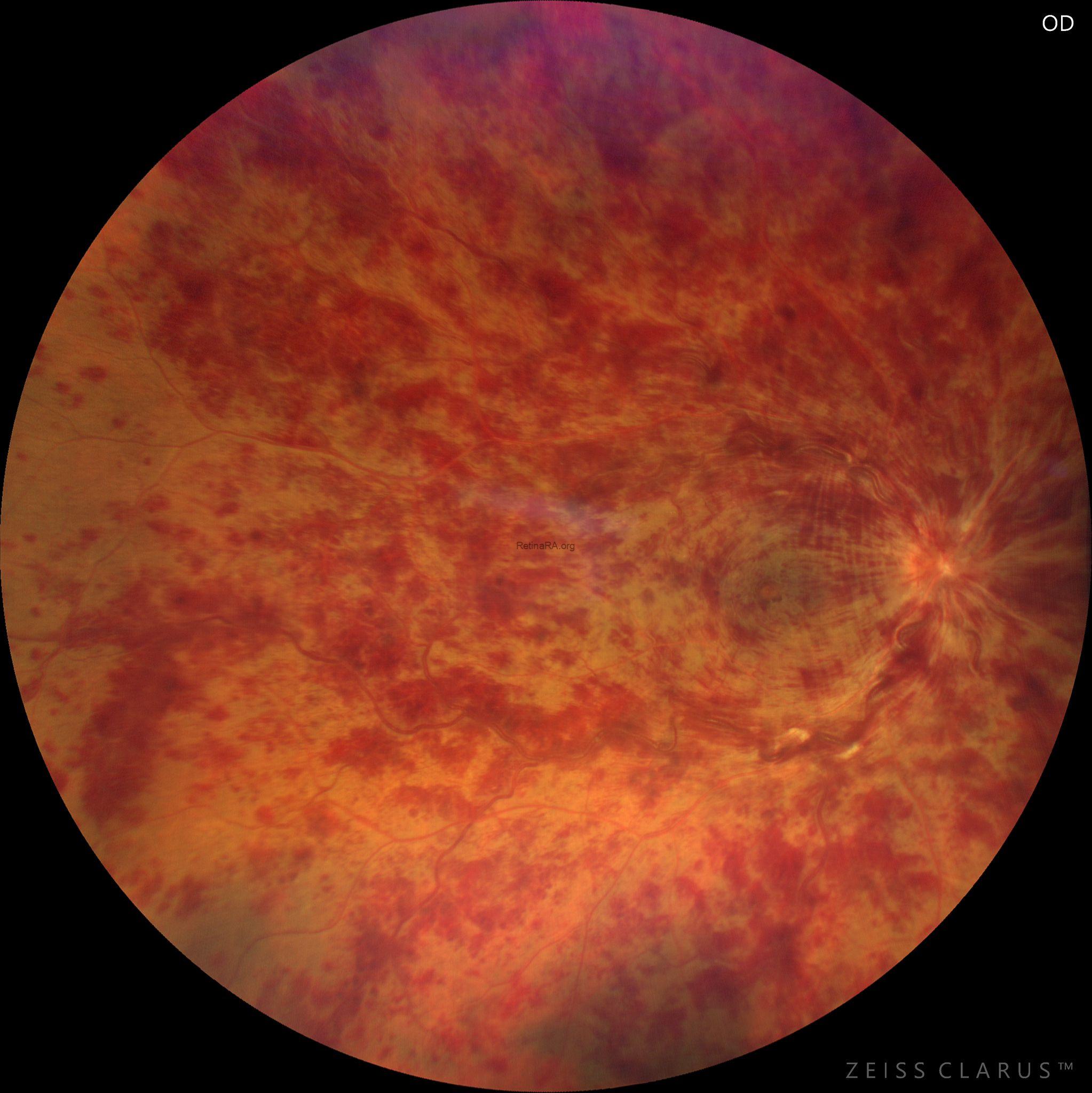 ischemic-CRVO