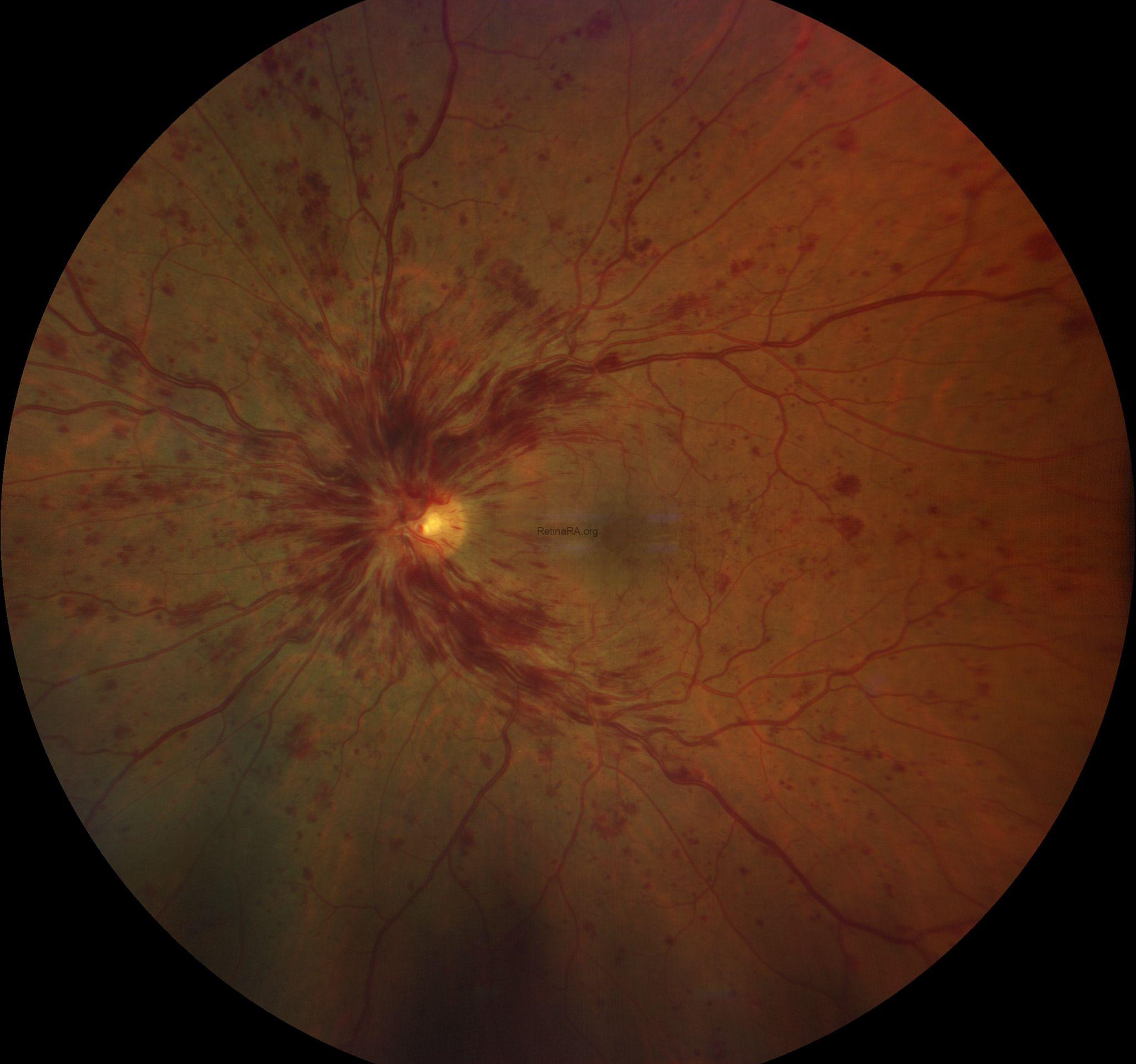 nonischemic-CRVOE1sYTNw