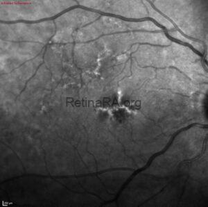 Butterfly-Shaped Pattern Dystrophy - RetinaRA
