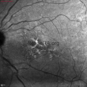 Butterfly-Shaped Pattern Dystrophy - RetinaRA